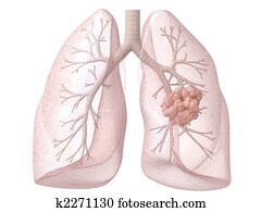 lung cancer lung cancer