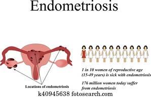 Endometrial Cancer Clipart | k33457215 | Fotosearch