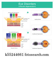 Macular degeneration is a medical condition which may result in blurred or no vision, Early on there are often no symptoms. Over time, however, some people experience a gradual worsening of vision that may affect one or both eyes. Illustration. Macular degeneration is a medical condition which may result in blurred or no vision, Early on there are often no symptoms. Over time, however, some people experience a gradual worsening of vision that may affect one or both eyes. Illustration.