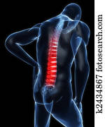 כאב גב, דוגמה