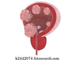 bladder cancer stages bladder cancer stages