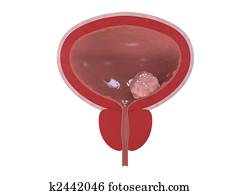 bladder cancer bladder cancer