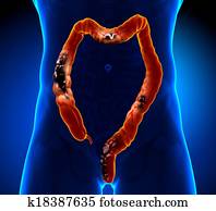 Colon Cancer / Colorectal cancer Colon Cancer / Colorectal cancer