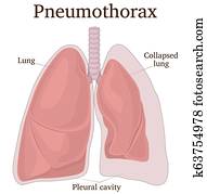 Illustration of Pneumothorax Illustration of Pneumothorax