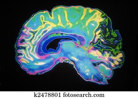 Coloured MRI Scan Of Human Brain Coloured MRI Scan Of Human Brain