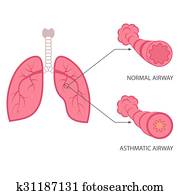 asthma asthma