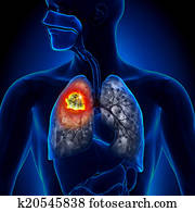 Lung Cancer - Tumor detail Lung Cancer - Tumor detail