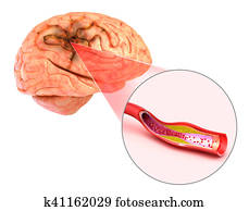 Brain stroke : 3d illustration of the vessels of the brain and causes of stroke Brain stroke : 3d illustration of the vessels of the brain and causes of stroke