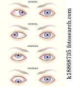 strabismus strabismus