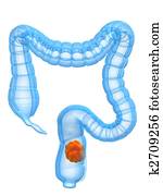 colon cancer colon cancer