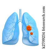 lung cancer lung cancer