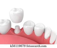 3d render of jaw with teeth and dental crown restoration 3d render of jaw with teeth and dental crown restoration