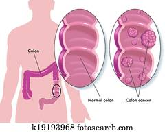 סרטן של קולון