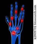 דלקת המפרקים