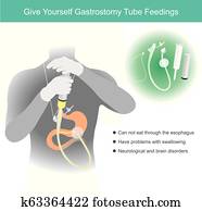 면하다, 당신 자신, gastrostomy, 튜브, feedings