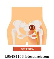 Sciatica bone disease sciatic back pain hip bone Sciatica bone disease sciatic back pain hip bone