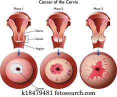 cervical, câncer