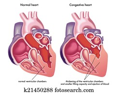 congestive, srdce