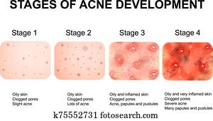stufen entwicklung, von, acne., entzündet, haut, mit, scars,, akne, und, pimples., dass, struktur, von, entzündet, skin,, und, akne, und, pimples., infographics., vektor, illustration. stufen entwicklung, von, acne., entzündet, haut, mit, scars,, akne, und, pimples., dass, struktur, von, entzündet, skin,, und, akne, und, pimples., infographics., vektor, illustration.