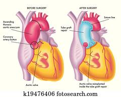 thoracic aortic aneurysm thoracic aortic aneurysm