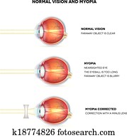 Myopia and normal vision. Myopia is being shortsighted. Myopia and normal vision. Myopia is being shortsighted.