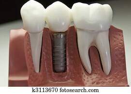 capped, dental, implante, modelo