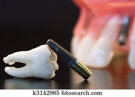 Dental implantation Dental implantation