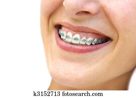 Teeth Braces Teeth Braces