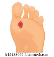 Diabetic foot. Clip Art | k9450727 | Fotosearch