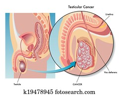testicular, câncer