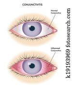 conjunctivitis
