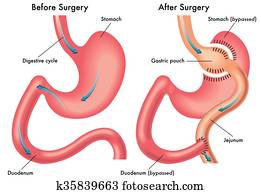 gastric bypass gastric bypass