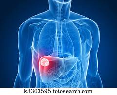 liver cancer liver cancer