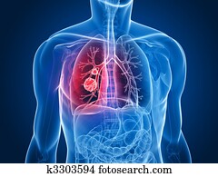 ריאה, גידול