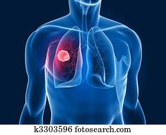 ריאה, גידול