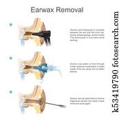 Earwax Removal. EARWAX s a common problem which is easily treated. Earwax Removal. EARWAX s a common problem which is easily treated.