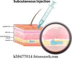 Skin subcutaneous Injection diagram Skin subcutaneous Injection diagram