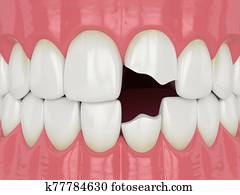 3d, render, של, לסת, עם, שבור, שיניים חותכות, שיניים