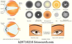 Cataract Cataract