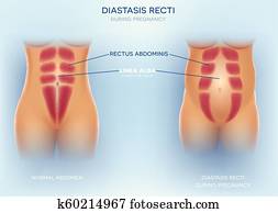 Diastasis Recti or abdominal separation Diastasis Recti or abdominal separation