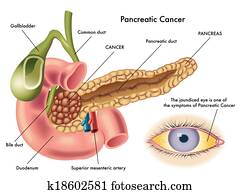 pancreatic cancer pancreatic cancer