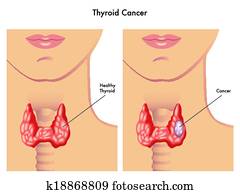 tiróide, câncer
