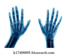 X-ray hand X-ray hand