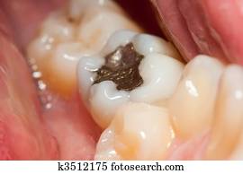 Amalgam filling Amalgam filling