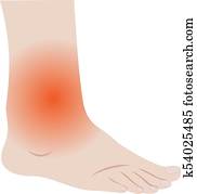 Clipart of Ankle sprains, k7993585 - Search Clip Art, Illustration ...