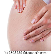 Stretch marks and cellulite