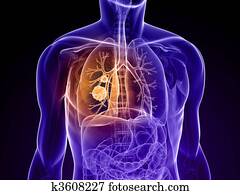 lung cancer lung cancer