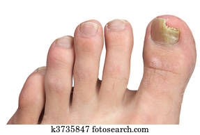 Toenail Fungus at Peak Infection