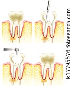 raiz, canal, processo