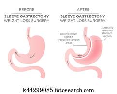 Stomach Staple Bariatric Surgery Resulting in 1/4 of the Stomach Removed. Stomach Staple Bariatric Surgery Resulting in 1/4 of the Stomach Removed.